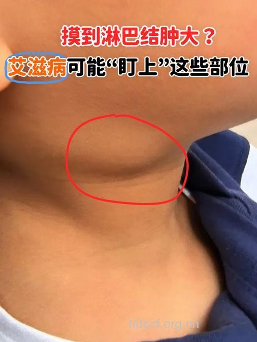 艾滋病初期症状之淋巴结肿大