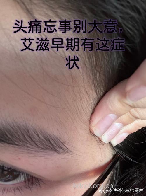 艾滋病初期症状之头痛