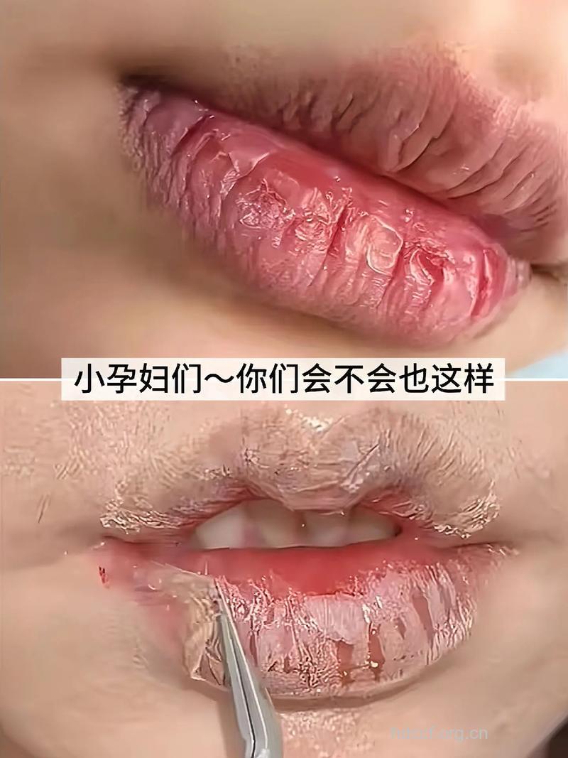孕妇要注意嘴唇卫生