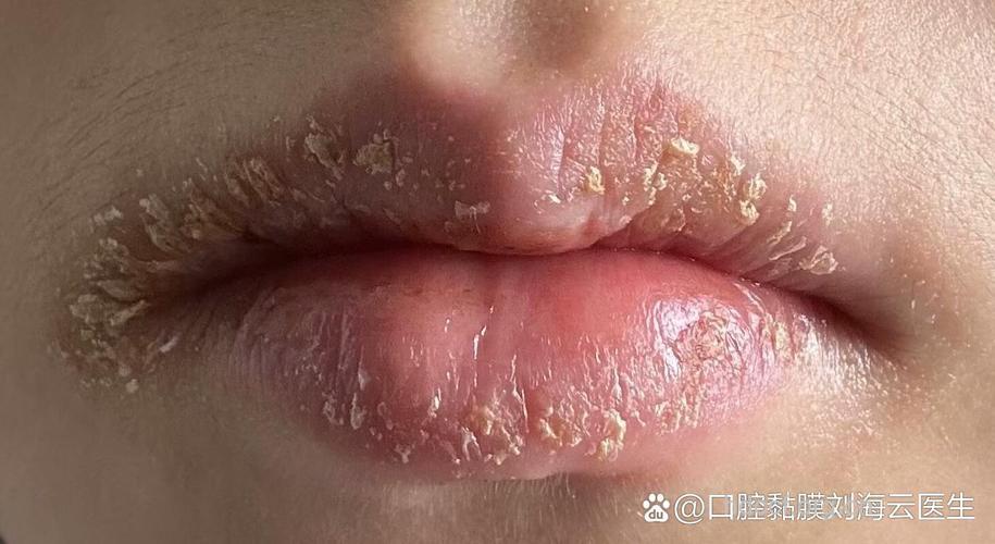 嘴唇干裂别用舌头舔唇