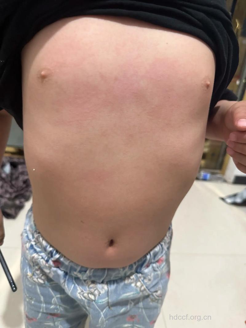 花粉皮肤过敏症状图片