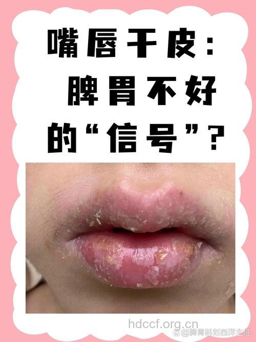 警惕嘴唇干裂可能与脾虚有关