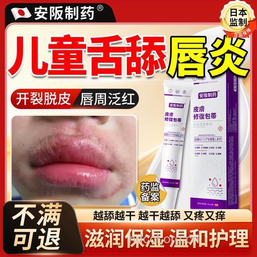 如何治疗小儿舌舔皮炎