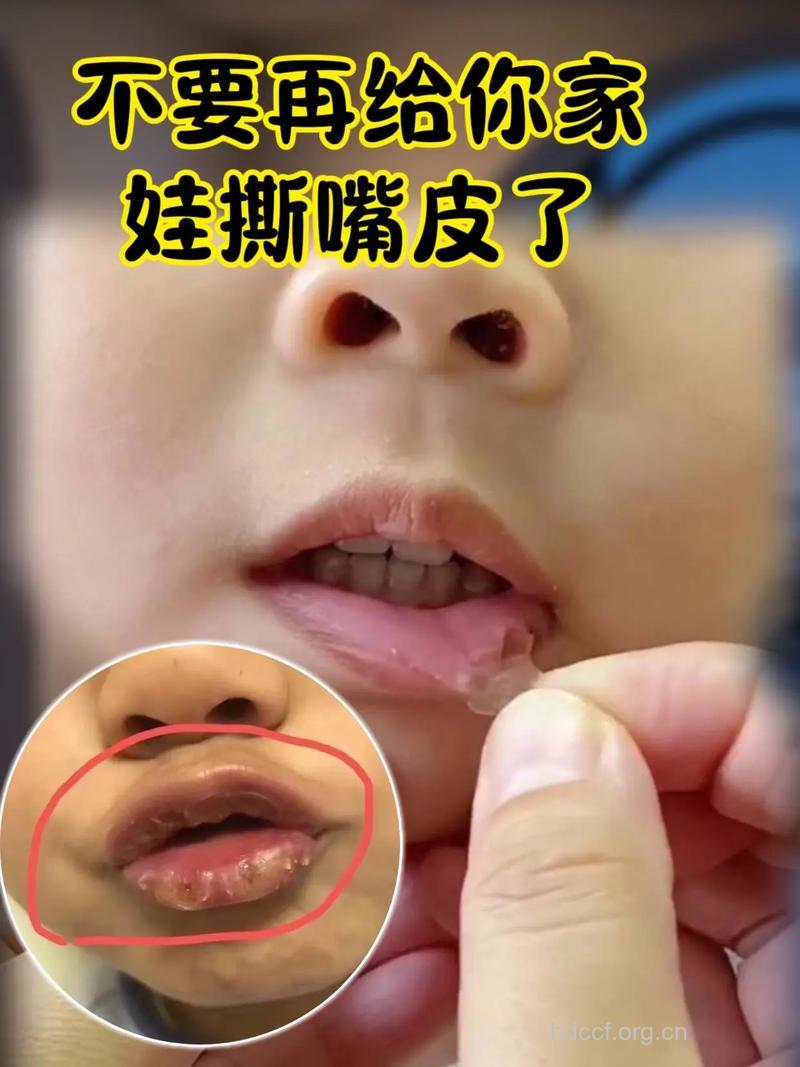宝宝嘴唇干 慎用润唇膏