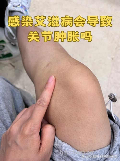 艾滋病患者的关节有什么症状？