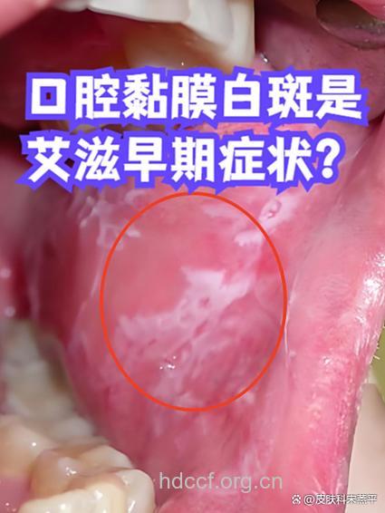 口腔布满“雪花”竟是艾滋作祟