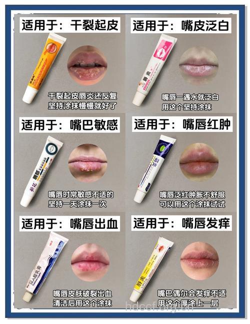 唇炎患者推荐实用的小偏方