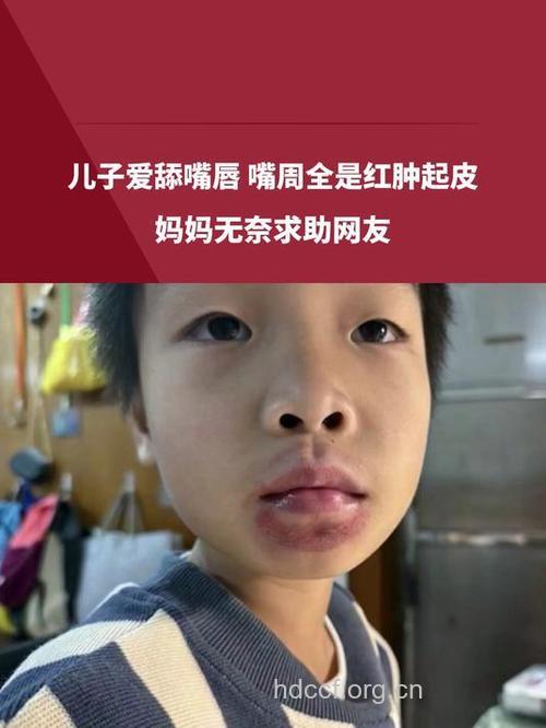 警惕:宝宝常舔嘴唇容易患皮炎