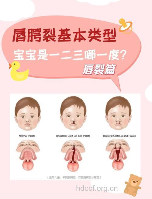 唇裂有哪些临床表现