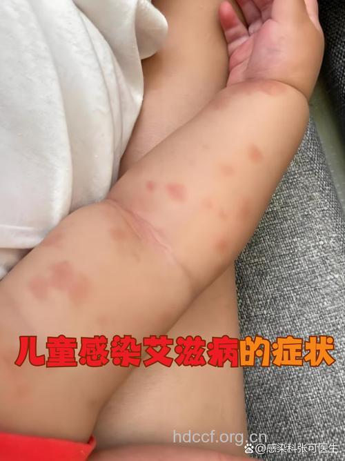 儿童感染艾滋的症状特点