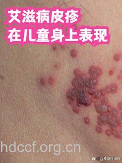 儿童反复咳嗽久治不愈有可能是艾滋症状