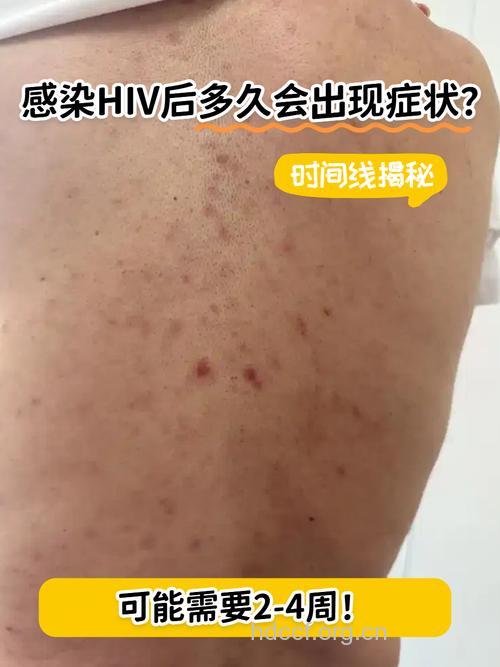 艾滋后期百病皆生