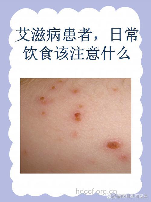 预防艾滋病吃什么好 六大食物远离艾滋