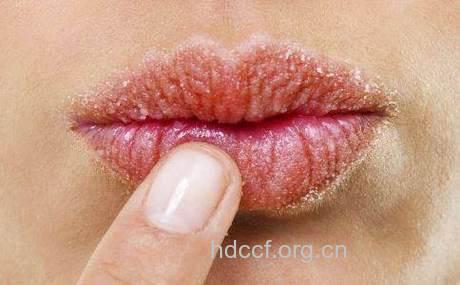 中西医结合防嘴唇干裂