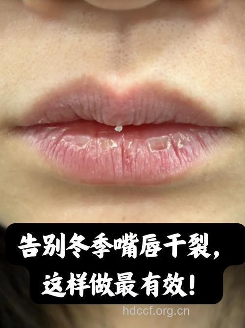 冬季,让你的嘴唇告别干燥!