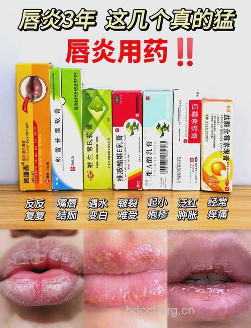 口服中成药治疗秋季嘴唇干裂