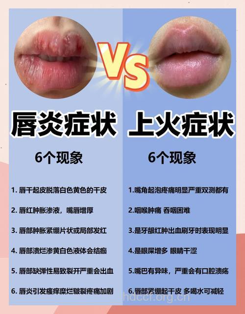 唇炎要与这些疾病区别开来