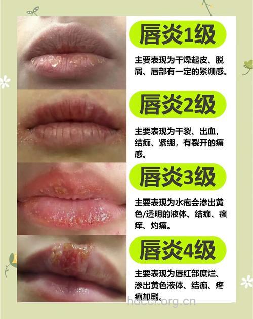 5个小妙招帮你治愈唇炎