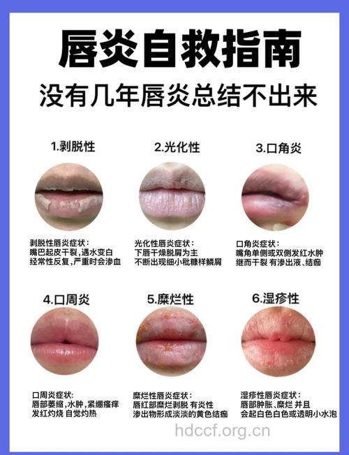 哪些原因会导致唇炎