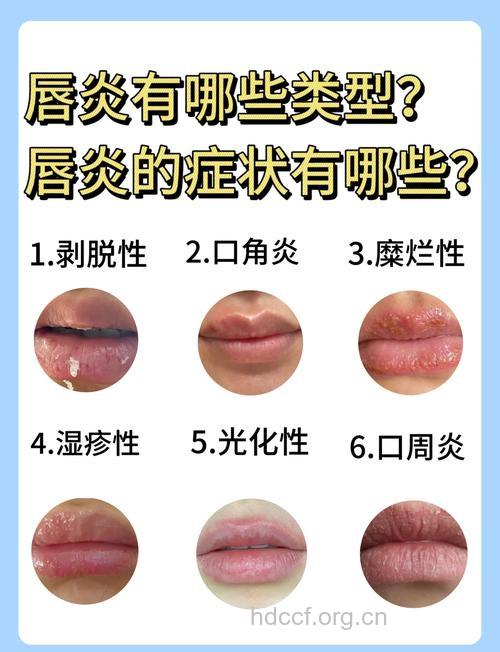 唇炎有哪些症状表现