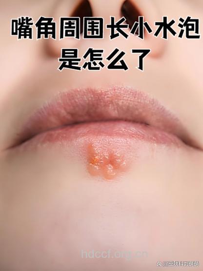 老是舔唇小心得慢性唇炎 多喝滋润汤水