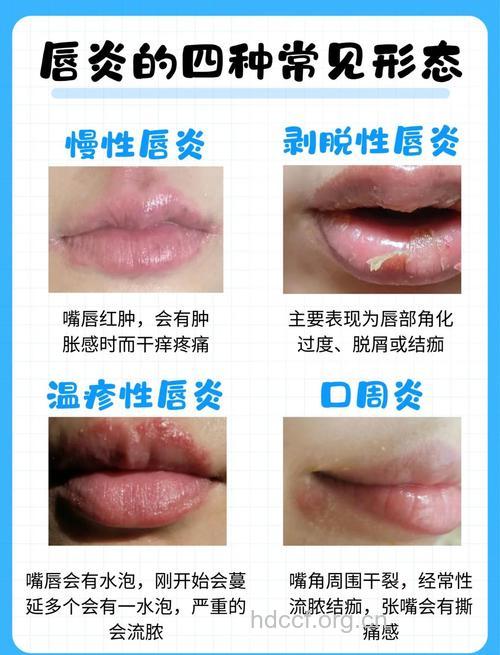 引发唇炎的三个因素