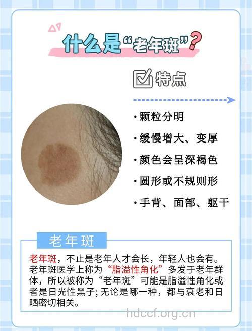 老年斑增多与痴呆的关系