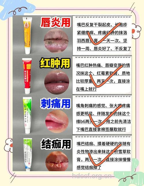 唇炎不建议用药治疗