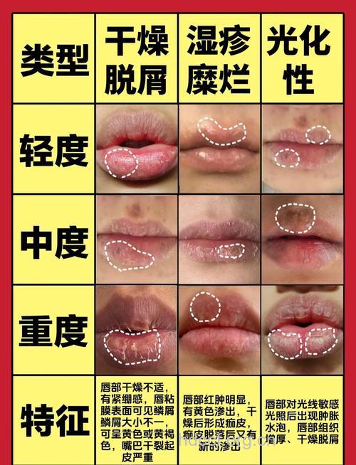 唇炎的症状及中药治疗方法