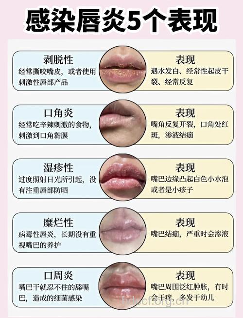夏季是唇炎发病季节