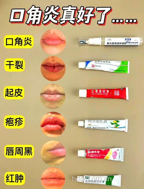 口角炎的治疗方法有哪些