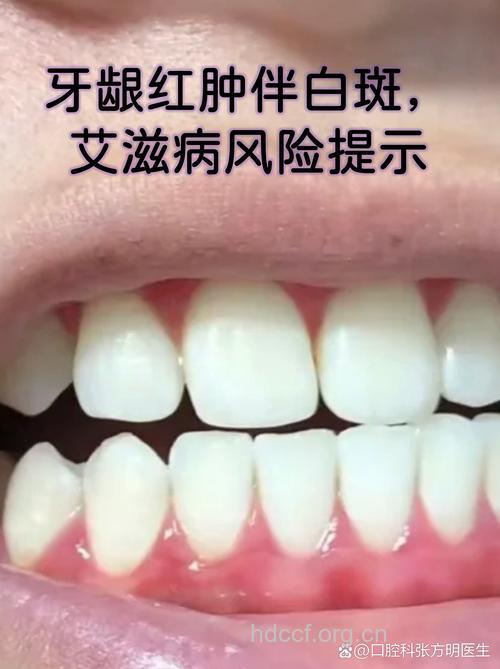 看牙齿会不会感染艾滋病