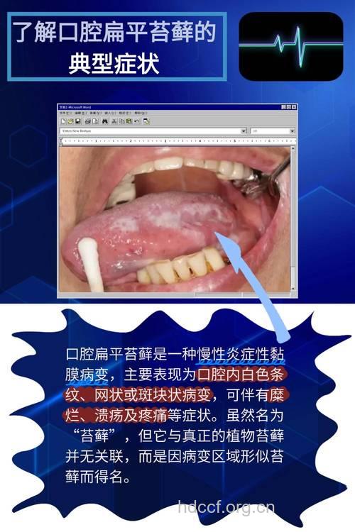 如何鉴别口腔扁平苔藓