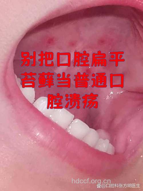 得了口腔扁平苔藓该怎么办
