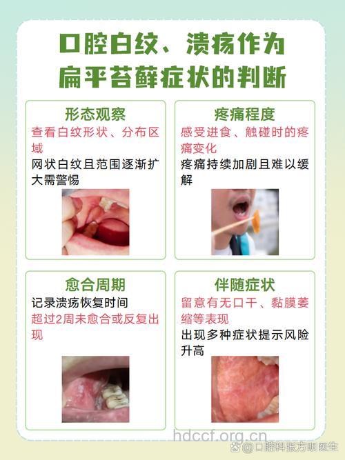 口腔扁平苔藓原因、症状及治疗