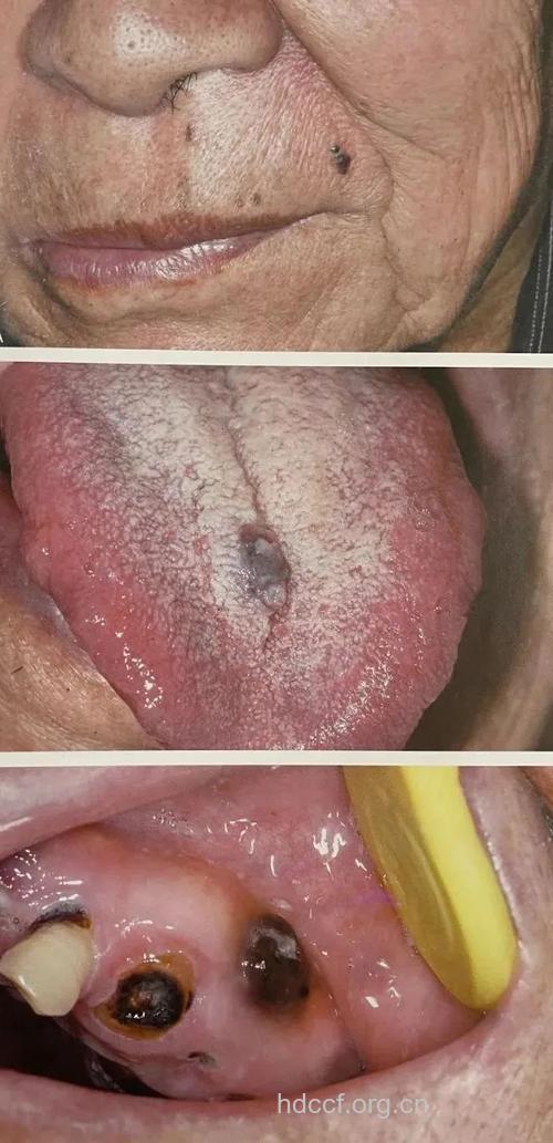 当心艾滋病人口腔病变