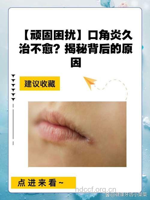 如何辨别口腔扁平苔藓与白斑