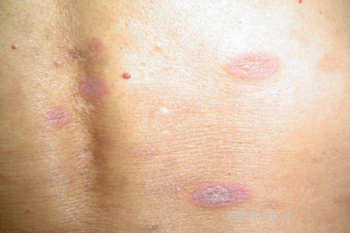 扁平苔藓的若干病态特征