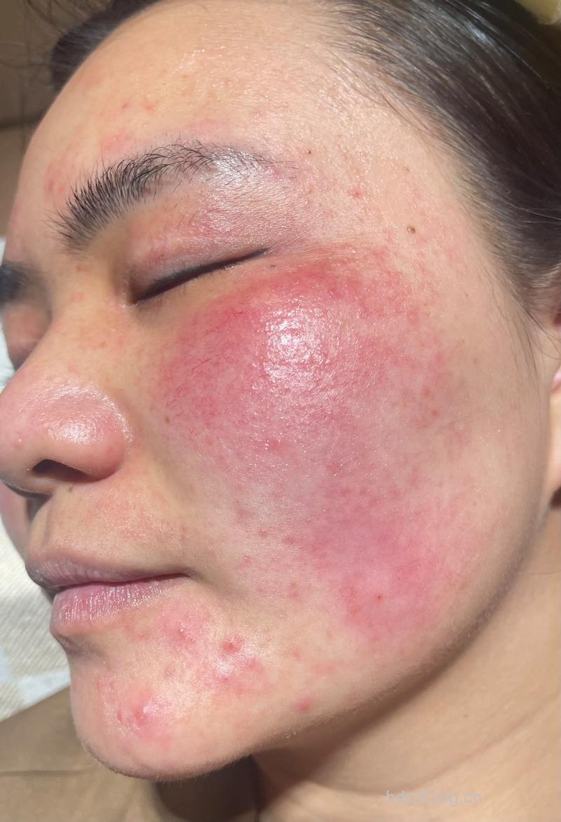 敏感肌肤容易引发红血丝