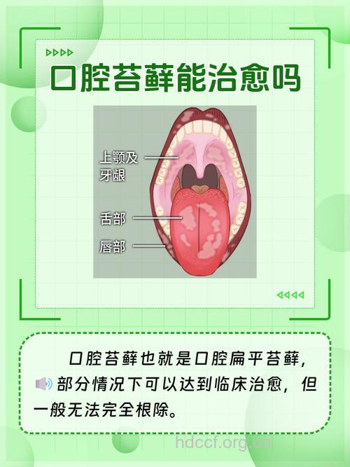 对于口腔扁平苔藓你了解多少