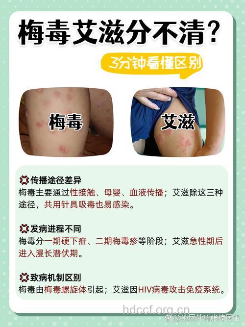 感染梅毒的人更易感染艾滋病