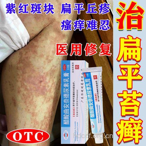 治疗扁平苔藓用什么药呢