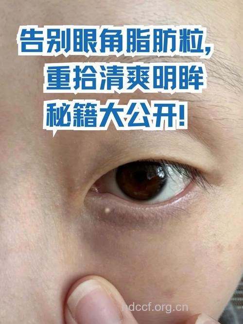 轻松应对脂肪粒还原动人双眸