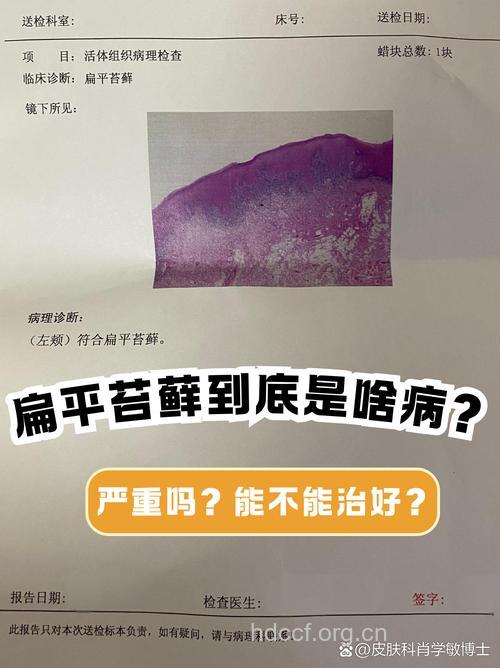 糖尿病对扁平苔藓有什么影响呢
