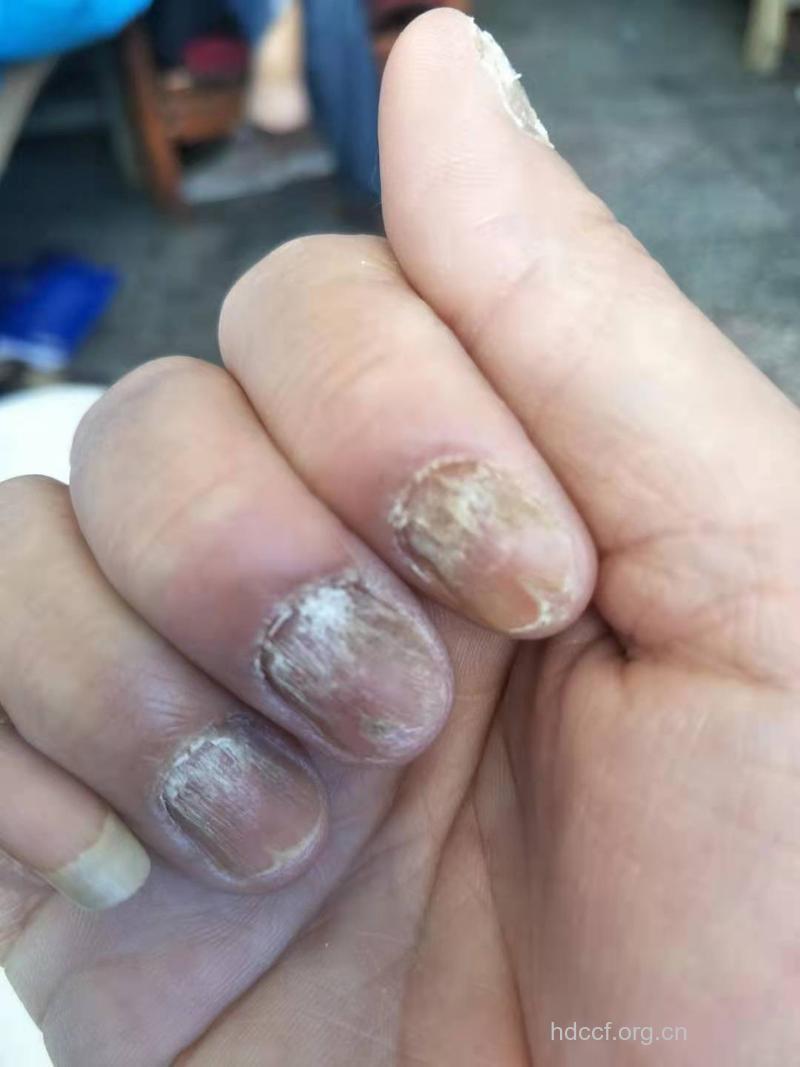 指甲扁平苔藓的症状是什么