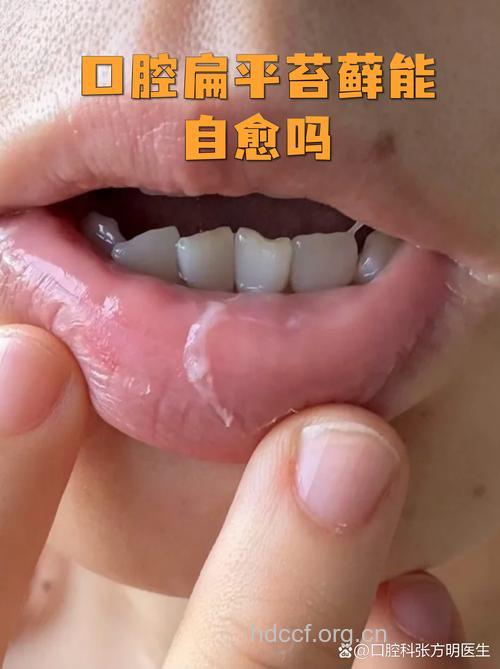 扁平苔藓可以痊愈吗
