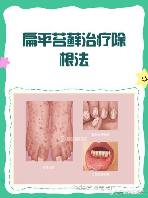 扁平苔藓的局部治疗方法