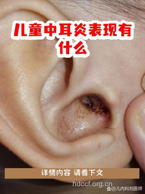 儿童中耳炎有哪些症状
