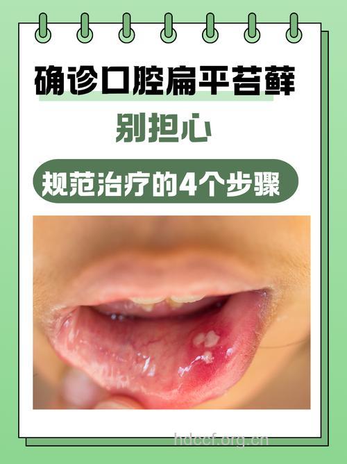 口腔扁平苔藓的诊断依据是什么