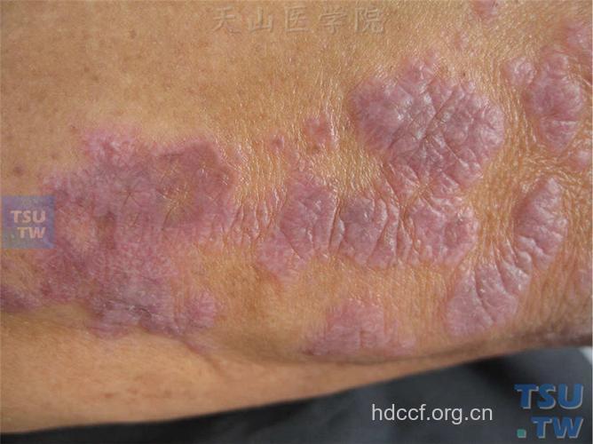 扁平苔藓疾病的特点是什么